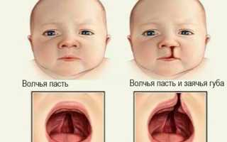 Дети с волчьим синдромом фото