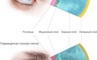Гели при синдроме сухих глаз