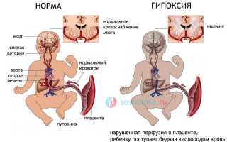 Ишемическое поражение цнс синдром двигательных нарушений