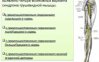 Физиолечение при синдроме грушевидной мышцы