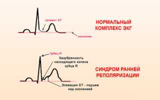Синдром ранней реполяризации желудочков при беременности что это