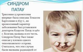Синдром патау трисомия по хромосоме 13