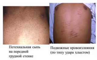 Геморрагический синдром что это такое