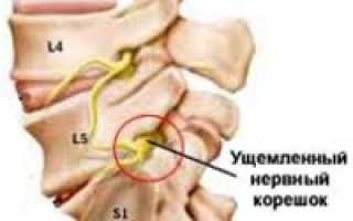 Синдром компрессии l5 корешка справа