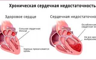 Синдром острой хронической сердечной недостаточности
