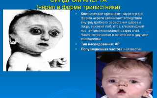 У моего ребенка синдром апера