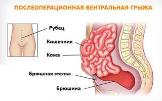 Ущемленная послеоперационная вентральная грыжа код мкб