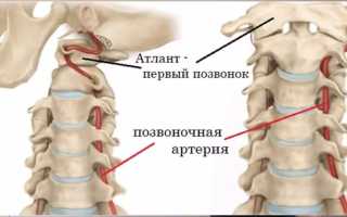 Синдром позвоночной артерии клиника лечение