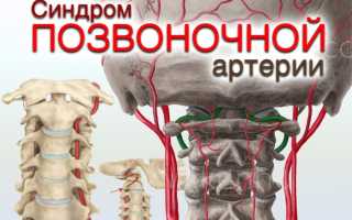 Синдром позвоночной артерии лечится он