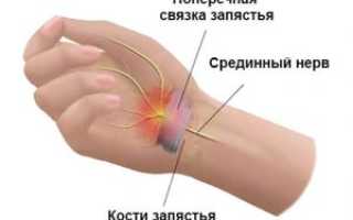 Туннельный синдром лечение при беременности