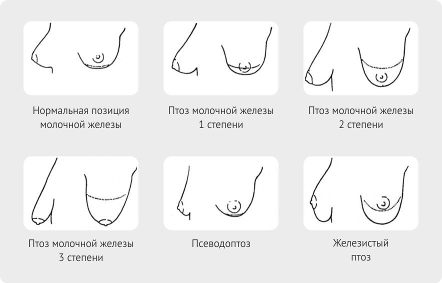 типы обвисания груди