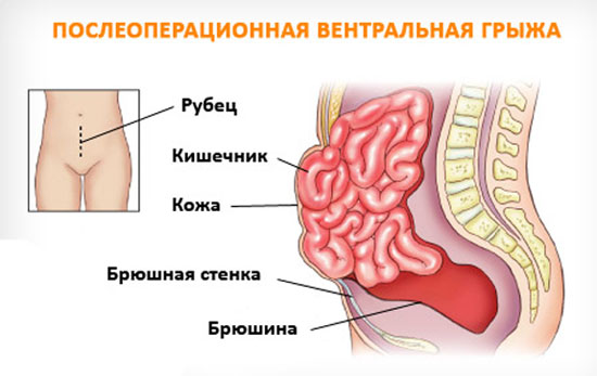 Ущемленная послеоперационная вентральная грыжа код мкб