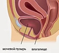 Цистоцеле