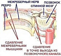 Межреберная невралгия