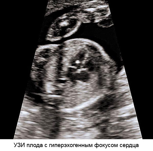 УЗИ плода с гиперэхогенным фокусом сердца