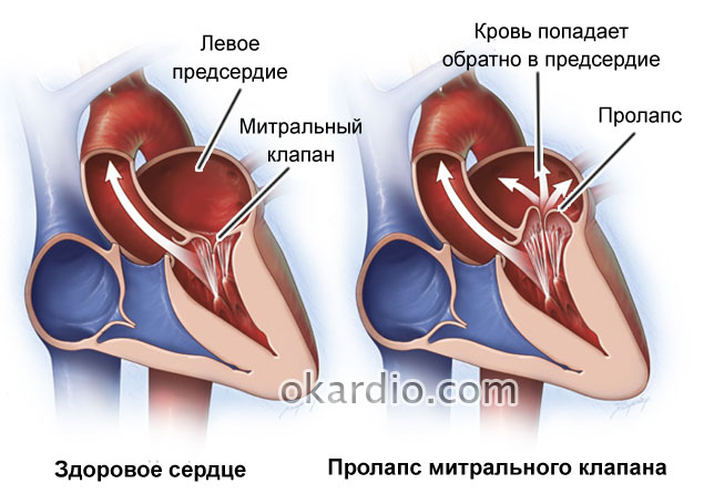 пролапс митрального клапана
