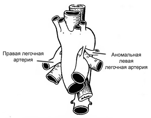 аномальная легочная артерия