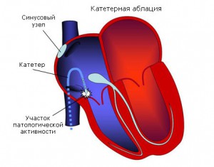 Экг синдром укороченного по интервала