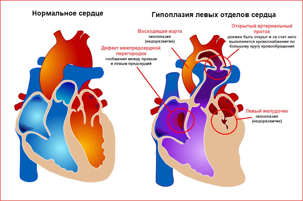 Гипоплазия левых отделов сердца