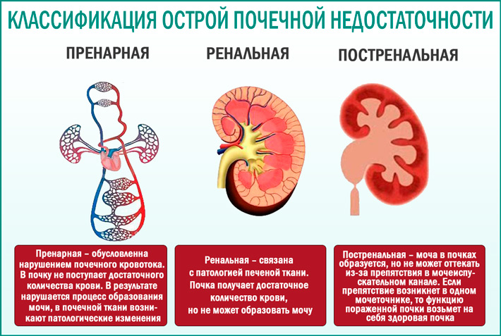 Острое повреждение почек: классификация 
