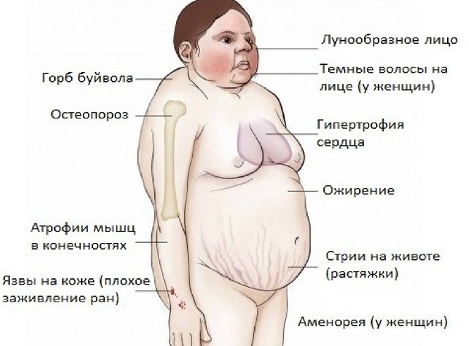 Синдром кушинга на лице фото