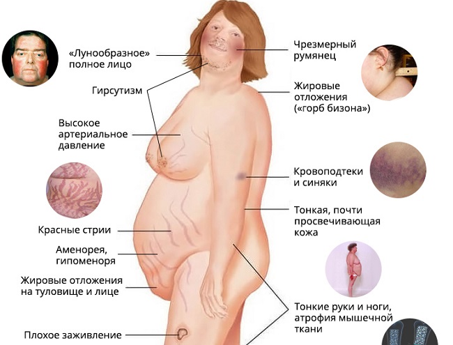 Синдром кушинга на лице фото