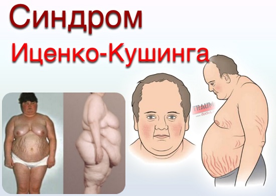 Синдром кушинга на лице фото