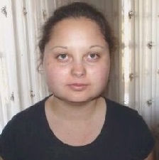 Синдром кушинга на лице фото