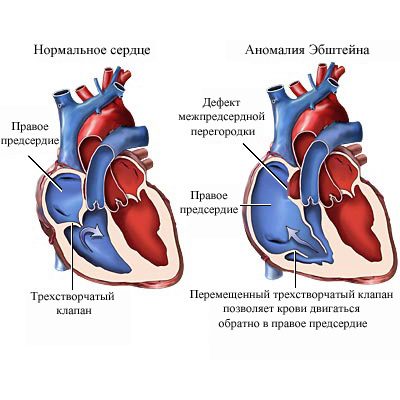 Гемодинамика при аномалии Эбштейна