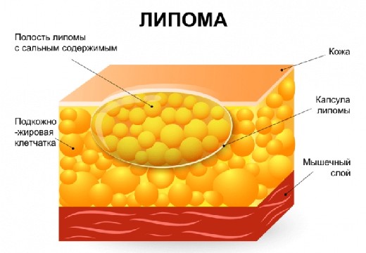 строение липомы