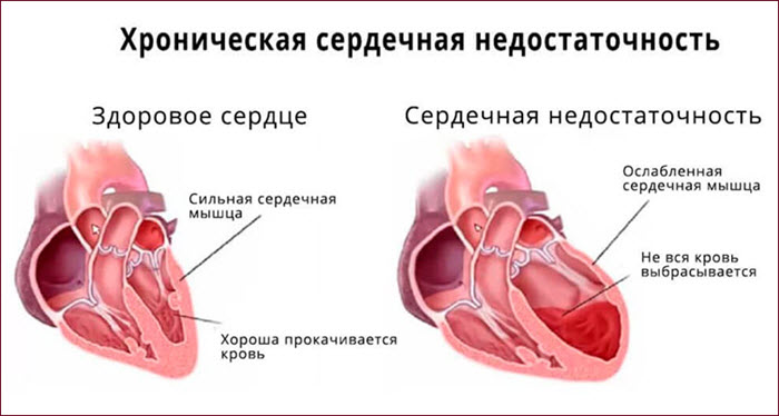 Здоровое и больное сердце