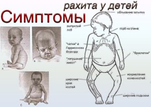 Заболевание рахит