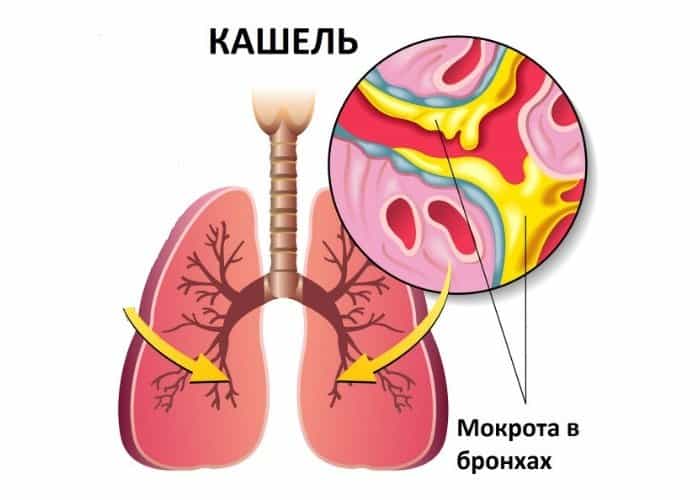 Главный симптом трахеобронхита - периодический или постоянный кашель
