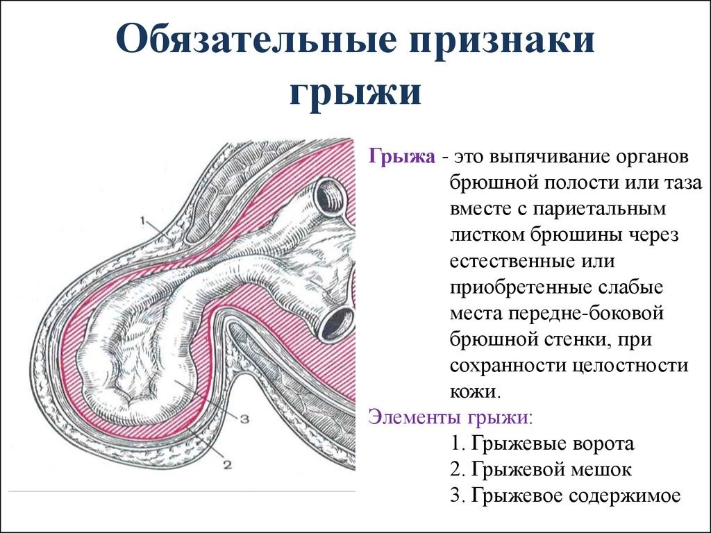 Ущемленная послеоперационная вентральная грыжа код мкб