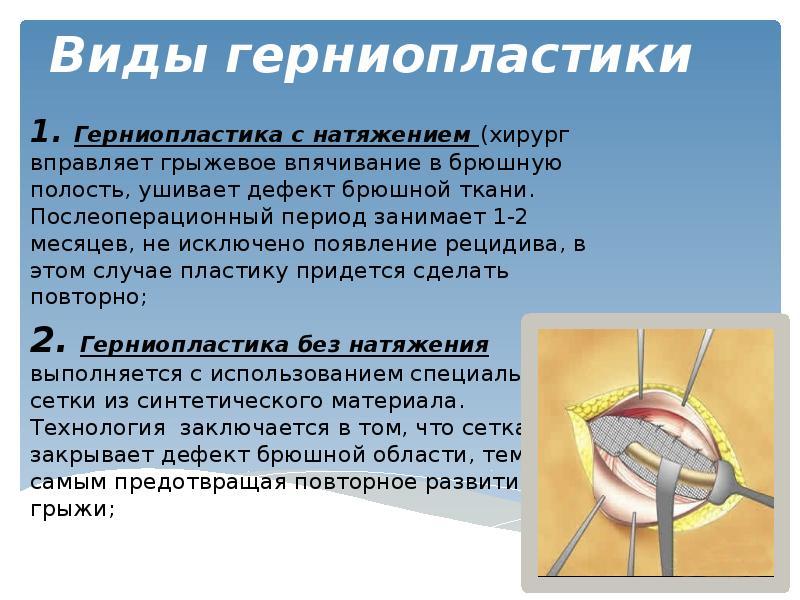 Ущемленная послеоперационная вентральная грыжа код мкб