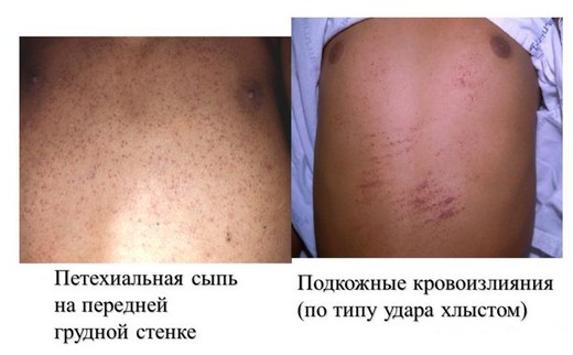 Проявления геморрагического синдрома