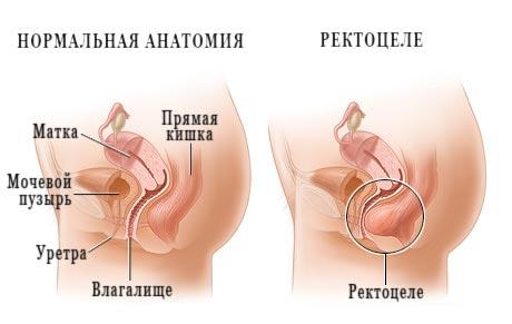 Дефект мышц промежности с формированием ректоцеле