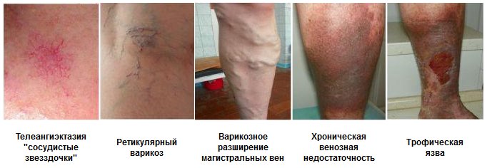 Тромбоз подколенных вен код мкб