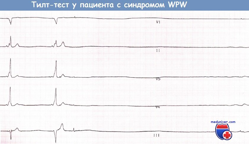 Тилт-тест при синдроме WPW и развитием нейрокардиогенного обморока на ЭКГ