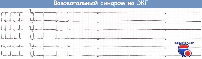 Нейрокардиогенный обморок (вазовагальный синдром) на ЭКГ