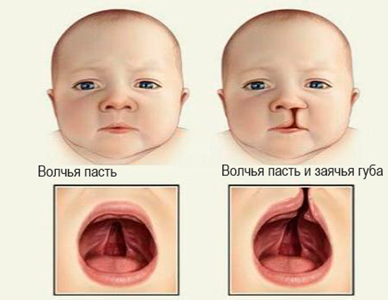 Дети с волчьим синдромом фото